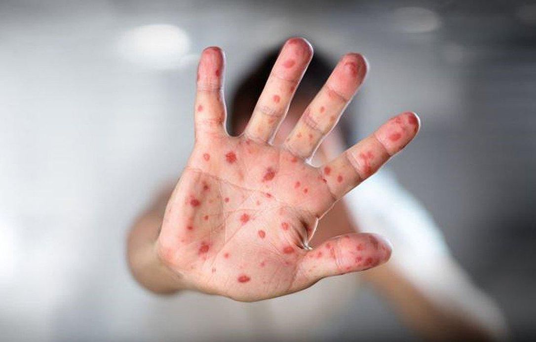 Rockland County measles outbreak hits 40, Rules for schools