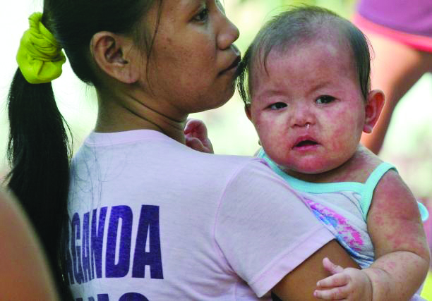Measles Measles is a highly contagious viral disease, according to the World Health Organization. It remains a common cause of death among young children globally despite the availability of a safe and effective vaccine. MAKABAYAN.PH