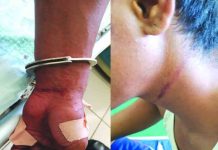 Police authorities place the 26-year-old rape suspect under hospital arrest after he attempted to end his life by slashing his wrist and hanging himself to a tree. The suspect reportedly admitted raping her niece on July 11 in Barangay Pampango, Libacao, Aklan. Police said his conscience bothered him. PHOTO COURESY OF RODNEL AGUIRRE