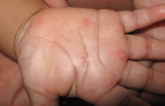 hfmd Photo courtesy of Grook Da Oger/Wikimedia Commons
