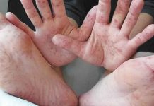 Hand-foot-and-mouth disease up 3,325% Hand-foot-and-mouth disease is a common infectious disease that occurs most often in children. In most cases, the symptoms are painful sores in the mouth, fever, and a rash with blisters on the feet, hands, and buttocks.