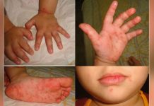 Health execs warn vs complacency as HFMD infections reach 178 While hand-foot-mouth-disease is contagious, it is self-limiting or can be cured in seven to 10 days. A case can only be considered serious if it has secondary infection which very rarely happens and Region 6 has not recorded any yet, according to the Department of Health.