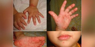 While hand-foot-mouth-disease is contagious, it is self-limiting or can be cured in seven to 10 days. A case can only be considered serious if it has secondary infection which very rarely happens and Region 6 has not recorded any yet, according to the Department of Health.
