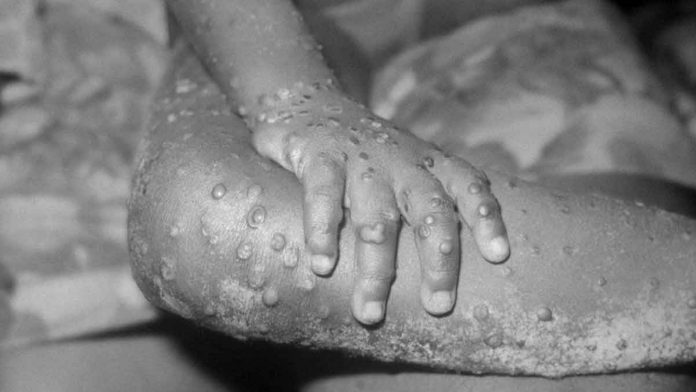 news-dom-pox Symptoms of monkeypox include a rash which starts on the face and spreads to the body. GETTY IMAGES