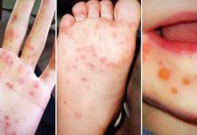 Hand Foot and Mouth Disease is a viral infection common in children under 10 years old. It is characterized by fluid-filled blisters appearing on the hands, feet and mouth with or without fever.