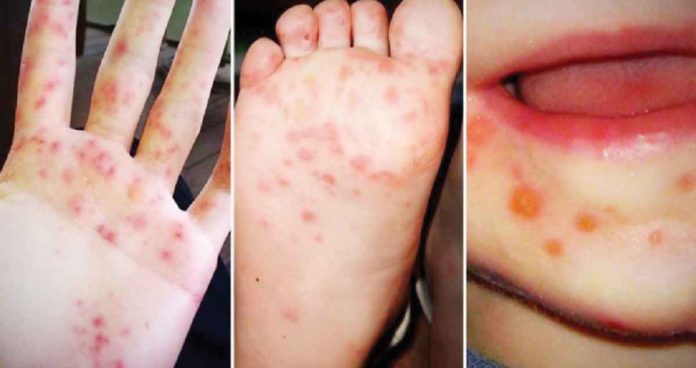 region-capiz-HFMD Hand Foot and Mouth Disease is a viral infection common in children under 10 years old. It is characterized by fluid-filled blisters appearing on the hands, feet and mouth with or without fever.