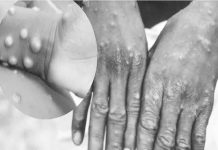 Monkeypox is a rare disease caused by infection with the monkeypox virus. Symptoms are similar to smallpox symptoms, but milder – rash with blisters on face, hands, feet, body, eyes, mouth or genitals; fever; swollen lymph nodes; headaches; muscle and back aches; and low energy.