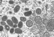 WV’s first monkeypox case already out of hospital Photo courtesy of Cynthia S. Goldsmith and Russell Regnery/CDC; AP