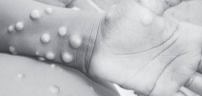 monkeypox Monkeypox is a rare disease caused by infection with the monkeypox virus. Its symptoms are similar to smallpox symptoms, but milder, and monkeypox is rarely fatal. WHO
