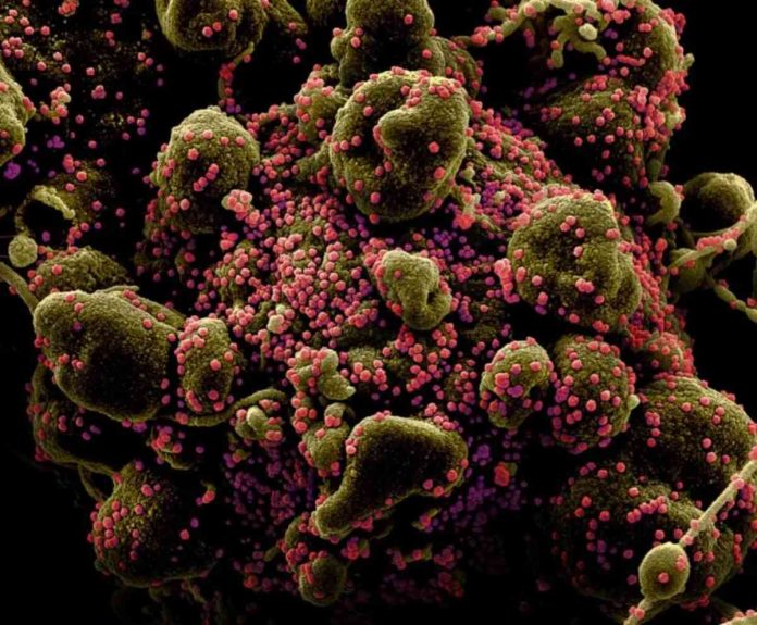apoptotic-cell-infected-w-covid Colorized scanning electron micrograph of an apoptotic cell (greenish brown) heavily infected with SARS-COV-2 virus particles (pink), also known as novel coronavirus, isolated from a patient sample. National Institute of Allergy and Infectious Diseases, NIH/Handout via REUTERS.