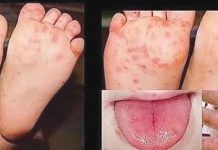 Hand-foot-mouth disease is a highly contagious disease common to children with symptoms including painful sores in the mouth, rash and blisters on feet, hands and buttocks and fever. It is spread from an infected person to others through close personal contact, and through the air when an infected person coughs or sneezes.