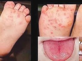 Hand-foot-mouth disease is a highly contagious disease common to children with symptoms including painful sores in the mouth, rash and blisters on feet, hands and buttocks and fever. It is spread from an infected person to others through close personal contact, and through the air when an infected person coughs or sneezes.