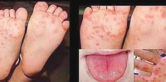Hand-foot-mouth disease is a highly contagious disease common to children with symptoms including painful sores in the mouth, rash and blisters on feet, hands and buttocks and fever. It is spread from an infected person to others through close personal contact, and through the air when an infected person coughs or sneezes.