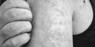 Rubella, also known as German measles, is caused by a different virus than measles. However, both are contagious and are transmitted when an infected individual coughs or sneezes. PHILIPPINE DAILY INQUIRER PHOTO