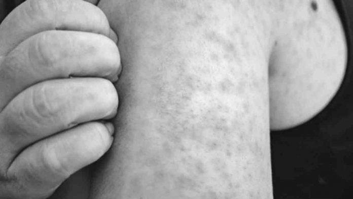nation DOH Rubella, also known as German measles, is caused by a different virus than measles. However, both are contagious and are transmitted when an infected individual coughs or sneezes. PHILIPPINE DAILY INQUIRER PHOTO