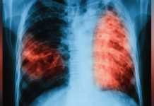 Capiz takes bold steps vs tuberculosis with innovative TIFA project