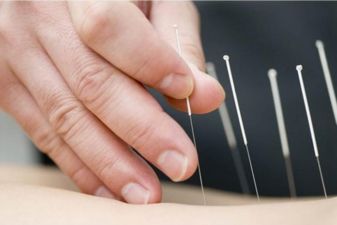 alternative_resized Acupuncture is a form of alternative medicine and a component of traditional Chinese medicine in which thin needles are inserted into the body. Stock image from Agence France-PresseAcupuncture is a form of alternative medicine and a component of traditional Chinese medicine in which thin needles are inserted into the body. Stock image from Agence France-Presse