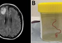 Live worm found in Australian woman’s brain in world first A brain scan and the parasite in a specimen jar. ANU