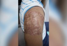 This Iloilo City Police Office policeman who asked that his identity be kept confidential shows to Panay News his previously tattooed arm. In 2010 or 14 years ago, he had the tattoo removed, and this is what remains. AJ PALCULLO/PN