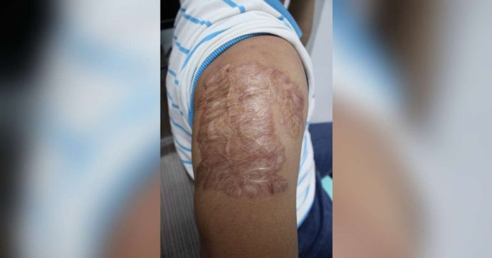 tattoo.JPG_superimposed This Iloilo City Police Office policeman who asked that his identity be kept confidential shows to Panay News his previously tattooed arm. In 2010 or 14 years ago, he had the tattoo removed, and this is what remains. AJ PALCULLO/PN