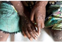 Mpox jumps between people through close contact, can cause symptoms such as fever, muscle aches and lesions across the body. REUTERS