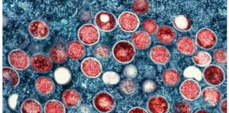 Image shows a transmission electron micrograph of monkeypox particles found within an infected cell. AP