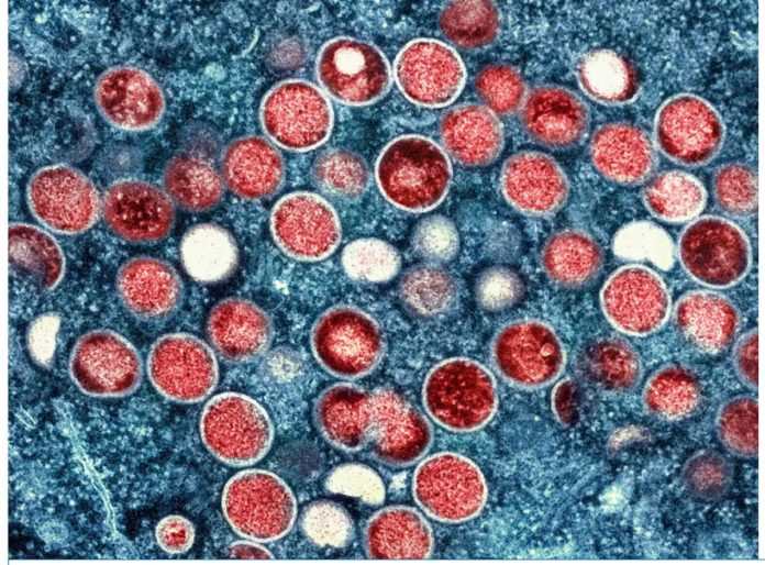 DOH Image shows a transmission electron micrograph of monkeypox particles found within an infected cell. AP