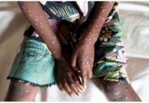 The World Health Organization has declared mpox a global public health emergency for the second time in two years, following an outbreak of the viral infection in Democratic Republic of Congo that has spread to neighboring African countries. REUTERS
