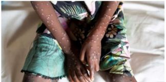 The World Health Organization has declared mpox a global public health emergency for the second time in two years, following an outbreak of the viral infection in Democratic Republic of Congo that has spread to neighboring African countries. REUTERS