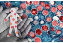 The World Health Organization says among the symptoms of mpox are skin rash or mucosal lesions, accompanied by fever, headache, muscle aches, back pain, low energy, and swollen lymph nodes. MPOX COMPOSITE IMAGE FROM AP AND INQUIRER STOCK PHOTOS