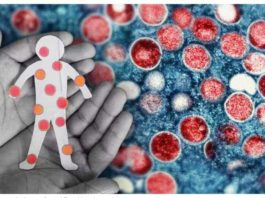 The World Health Organization says among the symptoms of mpox are skin rash or mucosal lesions, accompanied by fever, headache, muscle aches, back pain, low energy, and swollen lymph nodes. MPOX COMPOSITE IMAGE FROM AP AND INQUIRER STOCK PHOTOS
