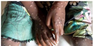 Mpox jumps between people through close contact, can cause symptoms such as fever, muscle aches and lesions across the body. REUTERS