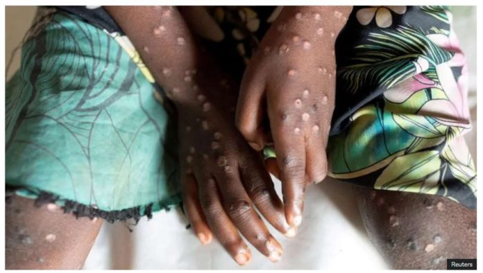 WHO_resized Mpox jumps between people through close contact, can cause symptoms such as fever, muscle aches and lesions across the body. REUTERS