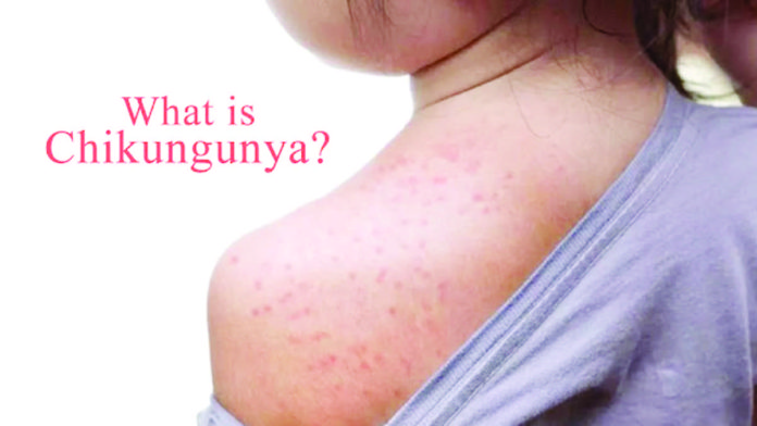 chikungunya_1_resized_resized Chikungunya symptoms include fever, joint pain, joint swelling, rashes, headache, body aches, nausea, and fatigue.