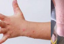 HFMD cases drop in Iloilo, but health execs brace for possible school reopening surge Blistering is one of the symptoms of hand, foot, and mouth disease (HFMD). Data from the Iloilo Provincial Health Office showed 723 cases were recorded in the province in 2024. PNA file photo