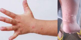 Blistering is one of the symptoms of hand, foot, and mouth disease (HFMD). Data from the Iloilo Provincial Health Office showed 723 cases were recorded in the province in 2024. PNA file photo
