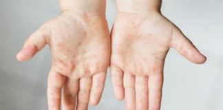 A child shows symptoms of hand, foot, and mouth disease in his hands. HFMD is a highly contagious viral disease that is common among children. The virus can be easily passed to other people through saliva droplets after an infected person sneezes, coughs, or talks. PIA