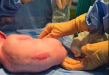 The first baby in the country to have undergone open fetal surgery was delivered safely two months after his operation, the Philippine Children’s Medical Center said. PHOTO FROM PCMC