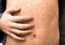 Bacolod urges parents to vaccinate children as measles cases rise A child's torso is covered with red spots of measles. Health experts warn that measles spreads very easily and can lead to some children suffering life-long consequences. Measles normally clears up within seven to 10 days. However, it can lead to pneumonia, meningitis, blindness and seizures. GETTY IMAGES