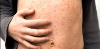 A child's torso is covered with red spots of measles. Health experts warn that measles spreads very easily and can lead to some children suffering life-long consequences. Measles normally clears up within seven to 10 days. However, it can lead to pneumonia, meningitis, blindness and seizures. GETTY IMAGES