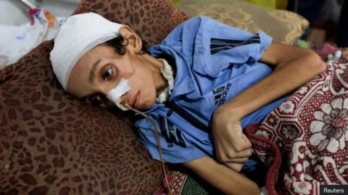 Gaza The United Nations says almost 100,000 women and children are suffering from severe acute malnutrition in Gaza. REUTERS