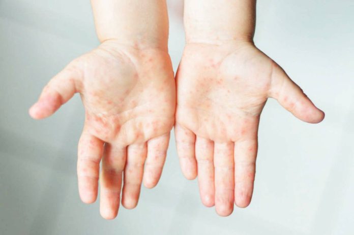 foot_and_mouth_resized Hand, foot and mouth disease cases this year have already reached 37,368 — more than seven times higher than the 5,081 cases logged over the same period in 2024, according to the Department of Health. PIA PHOTO