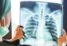 A health worker examines a chest X-ray, one of the key tools in detecting both active and hidden tuberculosis infections. The Department of Health – Region 6 urges adults to undergo x-rays every two years to help close the tuberculosis detection gap in Western Visayas. PHOTO FROM PHILIPPINE TUBERCULOSIS SOCIETY, INC.