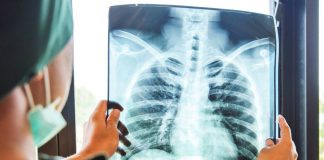 A health worker examines a chest X-ray, one of the key tools in detecting both active and hidden tuberculosis infections. The Department of Health – Region 6 urges adults to undergo x-rays every two years to help close the tuberculosis detection gap in Western Visayas. PHOTO FROM PHILIPPINE TUBERCULOSIS SOCIETY, INC.