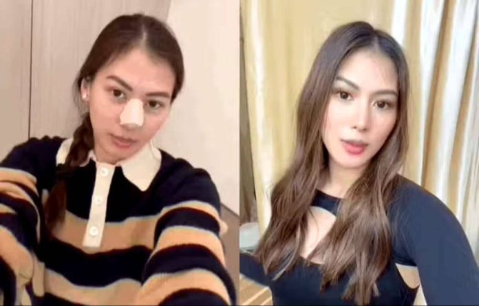 alex_gonzaga_copy_resized Alex Gonzaga reveals about having her Gore-Tex nose implant removed in July this year after having it for two years. SCREENGRAB FROM INSTAGRAM/@CATHYGONZAGA