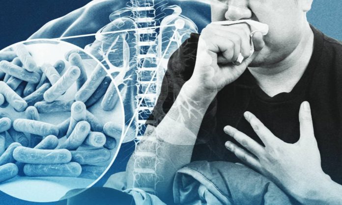 DOH The Philippines has the third highest burden of tuberculosis worldwide. INQUIRER FILE PHOTO