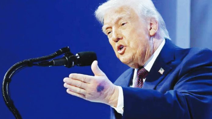 A bruise was clearly visible on United States President Donald Trump’s hand while he was speaking at the World Economic Forum in Davos, Switzerland earlier this year. GETTY IMAGES