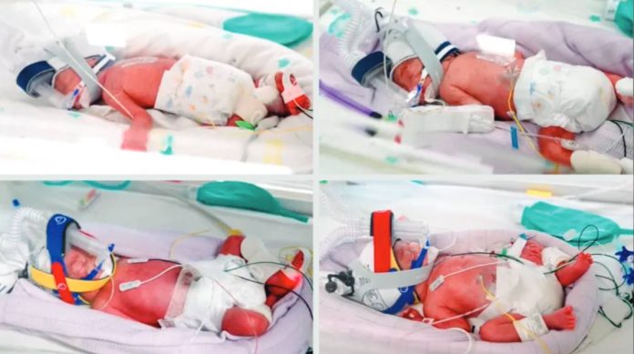 Naturally-conceived identical quadruplet babies born recently are all in the hospital's nursery, in an incubator, wearing a breathing device. METRO NORTH HEALTH