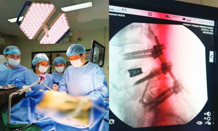 spine-surgery The Western Visayas Medical Center’s Neurosurgery Spine team performs the region’s first combined eXtreme Anterior Lumbar Interbody Fusion (XALIF) and Anterior-to-Psoas (ATP) spine surgery on a 63-year-old patient suffering from degenerative spine disease on September 19, 2026. The pioneering procedure, led by neurosurgeon Dr. Derek Ben T. Jabines, marks a major advancement in specialized spinal care, bringing complex surgical treatment closer to patients in Western Visayas. PHOTOS COURTESY OF WVMC